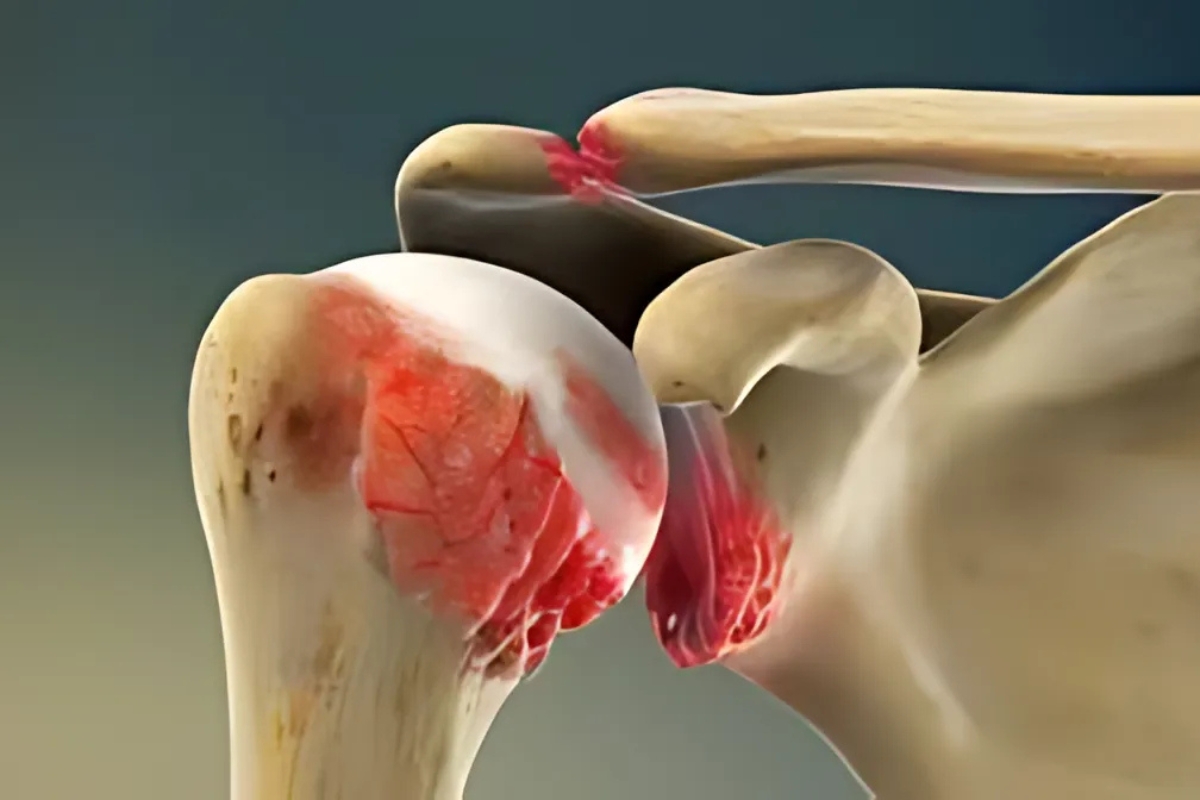 arthritida wmou apeikonisi