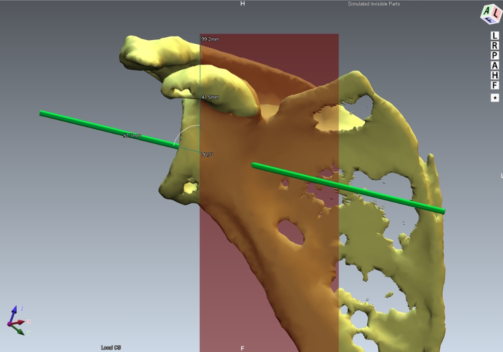 Προεγχειρητικός Σχεδιασμός Αρθροπλαστικής Ώμου