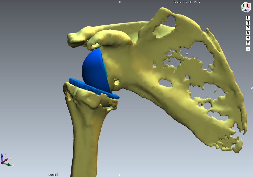 Προεγχειρητικός Σχεδιασμός Αρθροπλαστικής Ώμου
