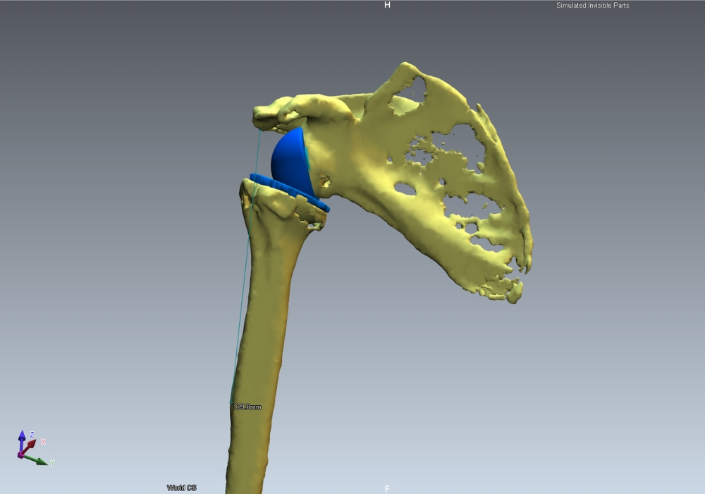 Προεγχειρητικός Σχεδιασμός Αρθροπλαστικής Ώμου