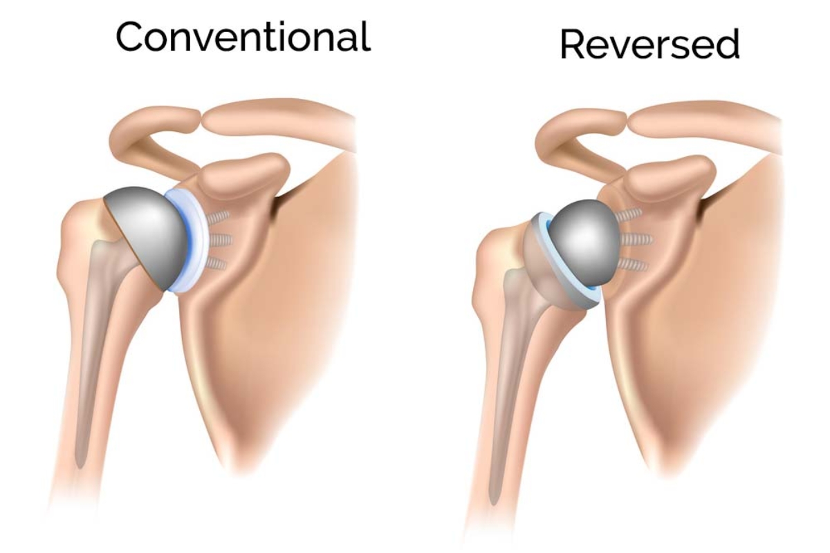 therapeia arthritidas