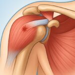 Μερική ρήξη τένοντα ώμου