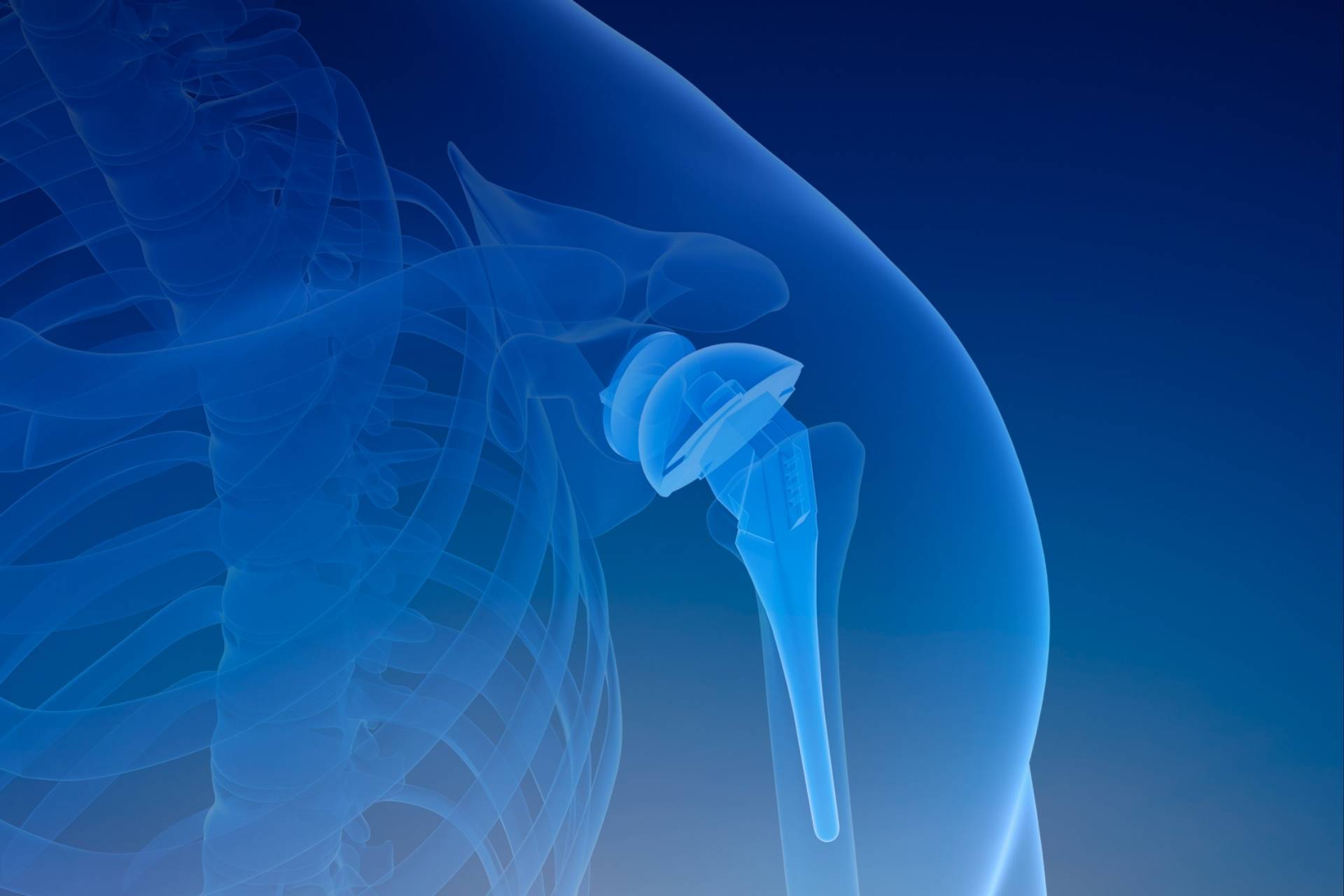 Ανάστροφη αρθροπλαστική ώμου