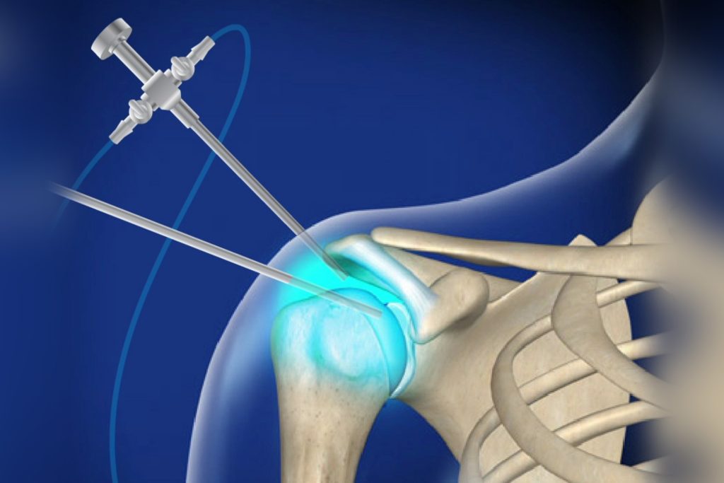 Shoulder Arthroscopy | Arthrojoint arthroskophsh wmoy